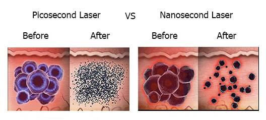 Picosecond vs Nanosecond Tattoo Laser Removal