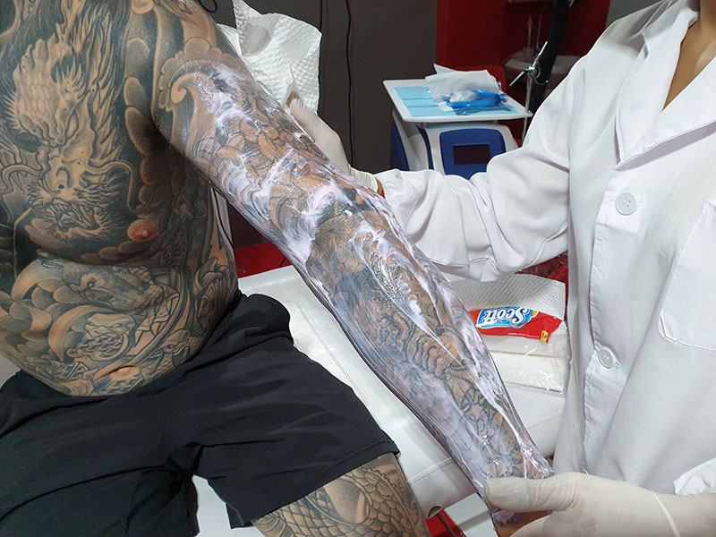 Tattoo Removal Bangkok