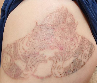 Laser Tattoo Removal Bangkok Thailand