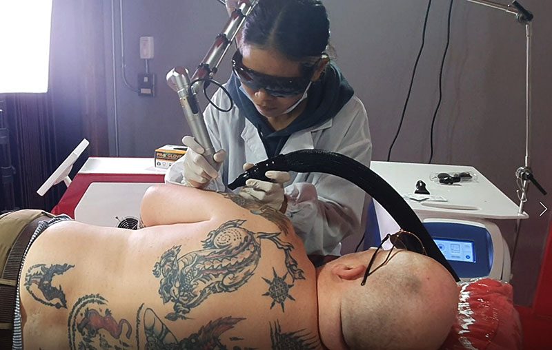 Tattoo Removal