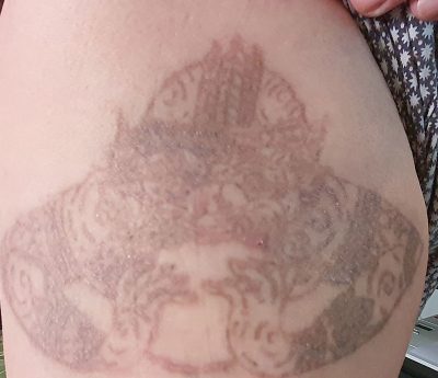 Tattoo Removal Bangkok Thailand